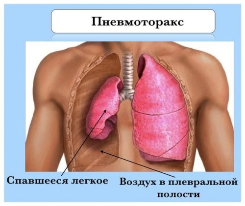 Оперативная торакоскопия. Пневмоторакс