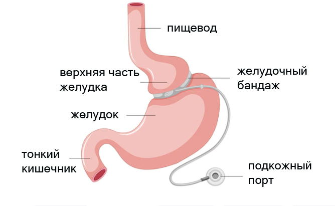 Лапароскопическое бандажирование желудка в хирургическом лечении морбидного ожирения