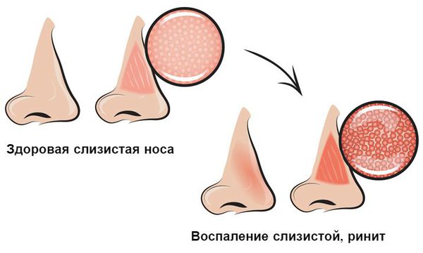 Эффективность профилактики травматического ринита после эндоназальных хирургических вмешательств