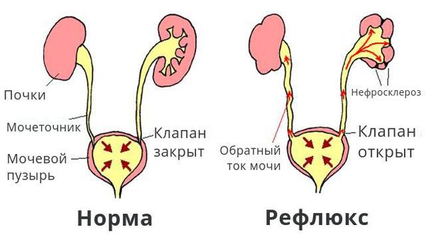 Осложнения эндоскопического лечения пузырно-мочеточникового рефлюкса у детей