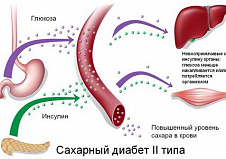 Столичные медики научились лечить самое страшное осложнение диабета