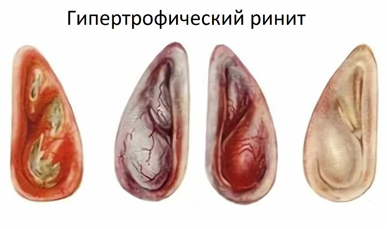 Тактика ведения послеоперационного периода больных гипертрофическим ринитом, перенесших эндоскопическое вмешательство