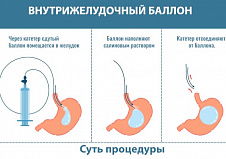 Какими хирургическими методами можно снизить вес?