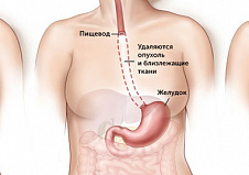 Резекция пищевода
