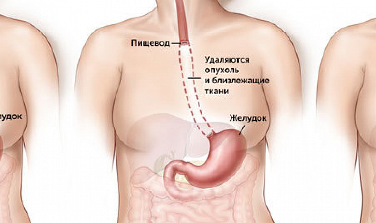 Резекция пищевода