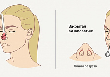 Новый способ ринопластики при ринолордозе