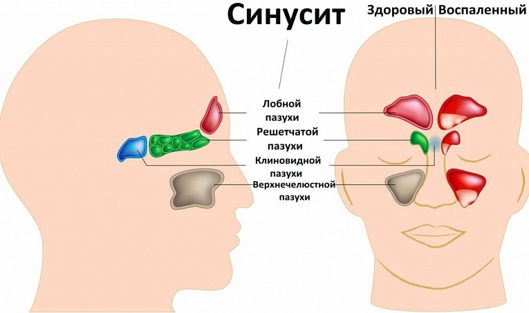 Эффективность щадящих методов лечения острых и хронических синуситов