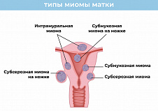 Лечение миомы матки