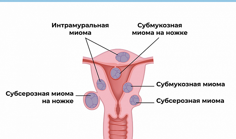 Лечение миомы матки