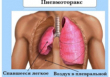 Оперативная торакоскопия. Пневмоторакс