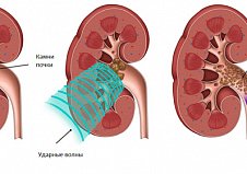 Ударно-волновая и уретероскопическая контактная литотрипсия - сопоставимые данные удаления камней верхней трети мочеточника