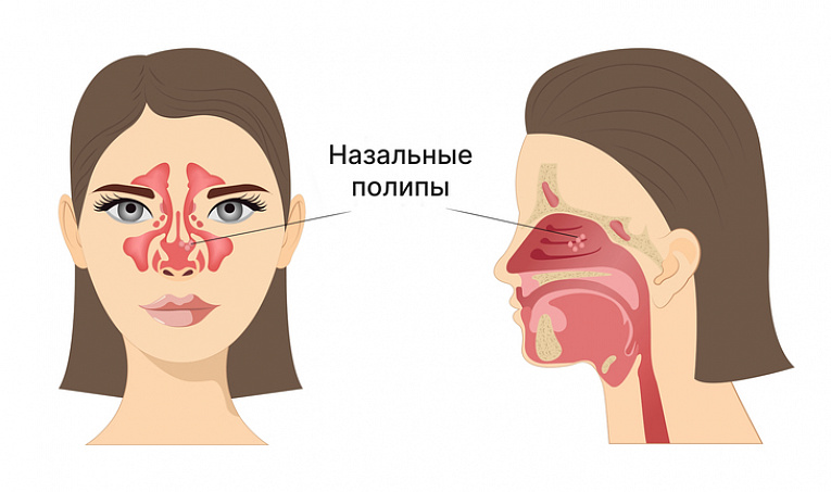 Лечение полипозного риносинусита