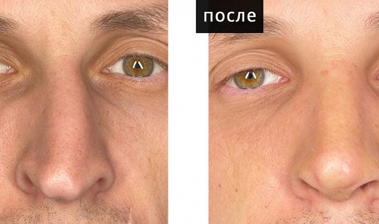 Эстетическая коррекция посттравматической деформации наружного носа