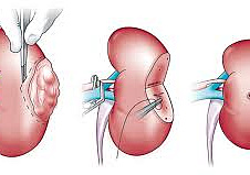 Проспективное исследование лапароскопической радикальной нефрэктомии при опухолях Т1-какой метод выбрать: трансперитонеальный, ретроперитонеальный или ручное пособие?