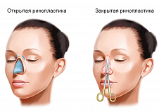 Новый способ ринопластики при ринолордозе