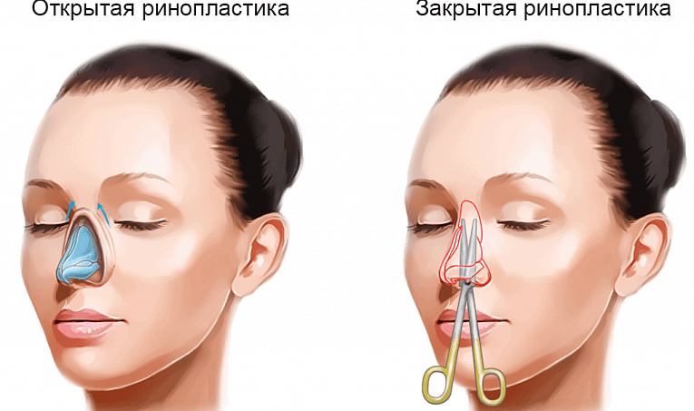 Новый способ ринопластики при ринолордозе