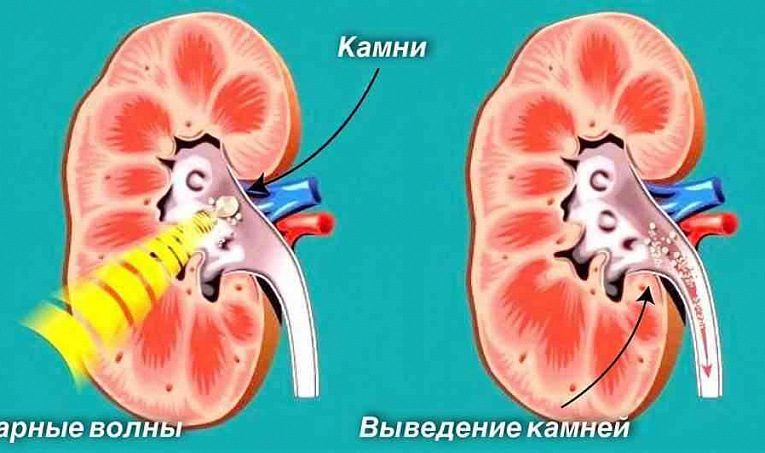 Проспективное рандомизированное исследование по сравнению ударно-волновой литотрипсии и уретероскопической литотрипсии в лечении больных c камнями верхней трети мочеточника