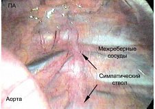 Видеоэндоскопическая симпатэктомия в лечении окклюзионных поражений конечностей у лиц с высоким риском